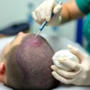 Hair Transplant Surgery